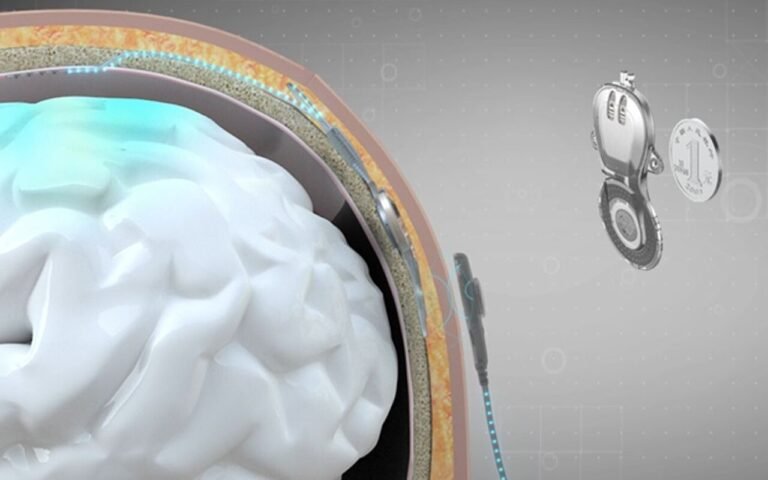 La Chine commercialise le premier implant cerveau-machine de l’histoire et laisse Neuralink d’Elon Musk encore bloqué aux essais cliniques